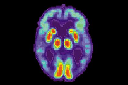 В исследовании болезни Альцгеймера сделан прорыв