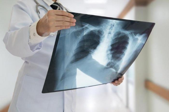 Коронавирусной пневмонией заболели 376 человек за сутки в РК