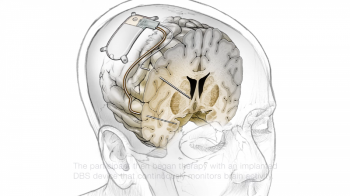 Ученые создали мозговой имплант для борьбы с депрессией
                06 октября 2021, 15:41