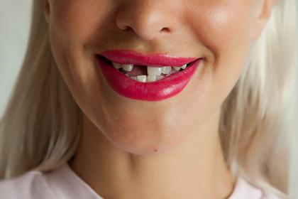 Женщина не смогла попасть к бесплатному стоматологу и вырвала себе 11 зубов