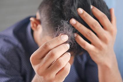 Российский врач назвала способы остановить выпадения волос после COVID-19
