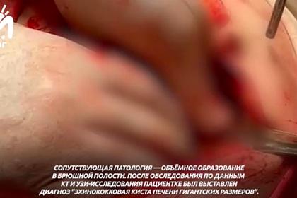 Врач из Дагестана спас пораженную пятикилограммовым паразитом печень девушки