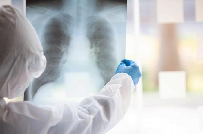 74 человека заболели ковид-пневмонией за сутки в РК