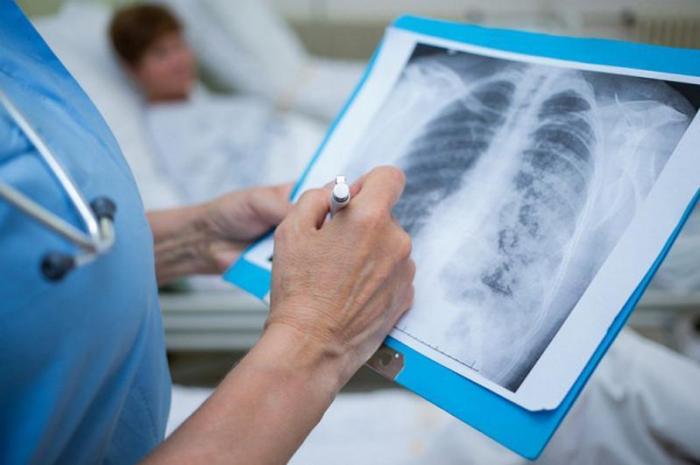 14 случаев ковидной пневмонии выявили в Казахстане за сутки