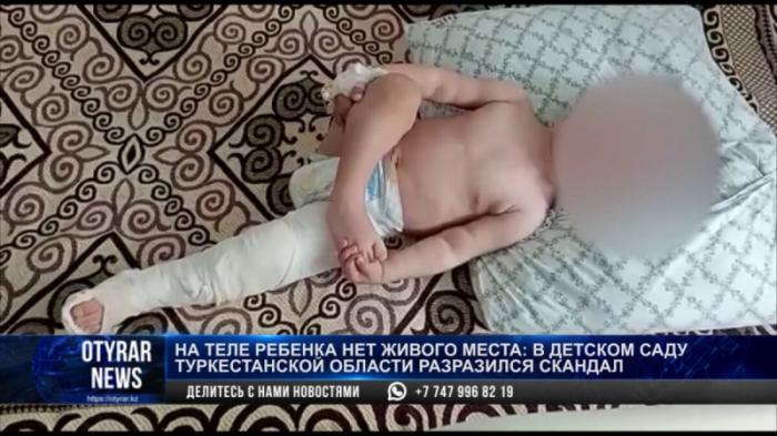 1,5-годовалого малыша прооперировали вскоре после его отъезда в детсад на юге Казахстана
                15 апреля 2022, 02:59