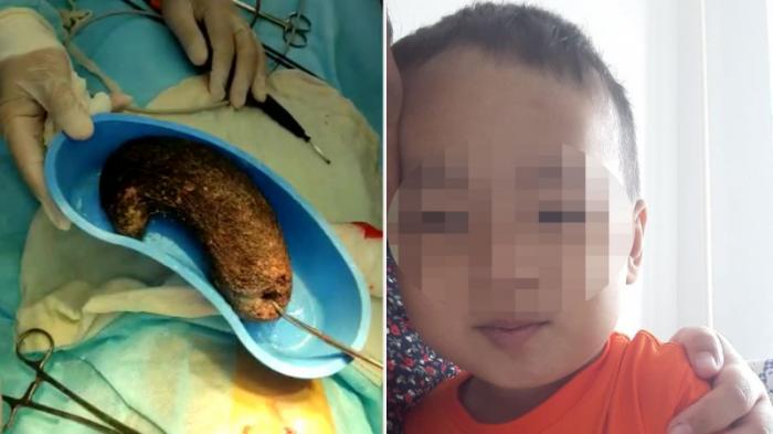 Полтора килограмма волос извлекли хирурги из желудка 4-летнего малыша в Кызылординской области
                30 мая 2022, 14:26
