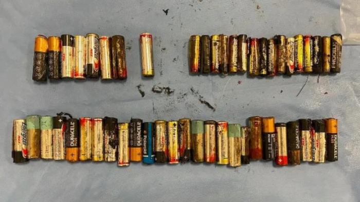 Врачи извлекли 55 батареек из желудка женщины
                20 сентября 2022, 07:03