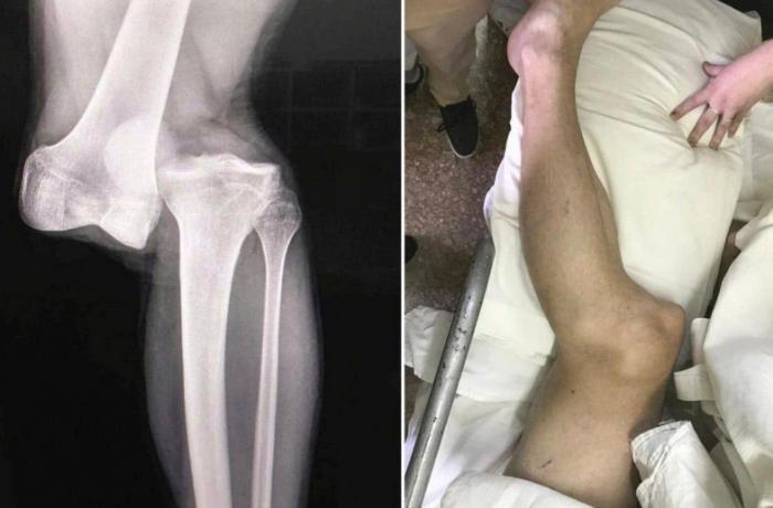Разрыв связок и разделение костей: опубликован жуткий рентген ноги игрока, которого «сломал» Марсело